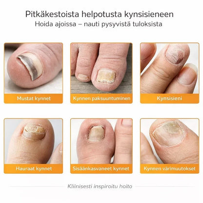 KynsiHoito – Tehokas hoito kynsisientä vastaan